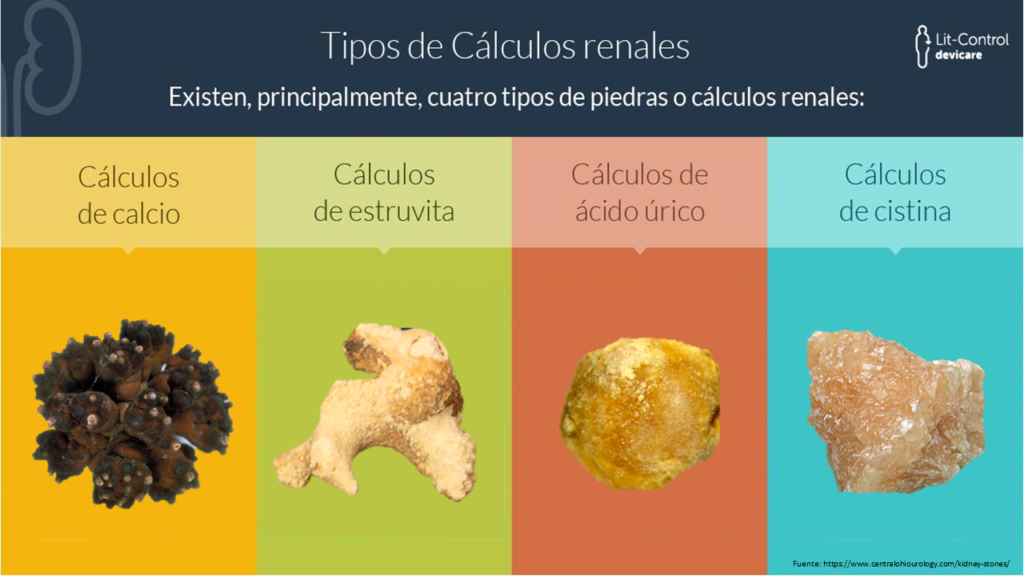 tipos de cálculos renales